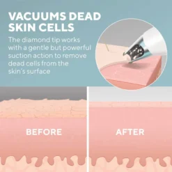 HoMedics Remove Microderm With Cooling -Professional Care Product Stores 13449404 1904937385374097